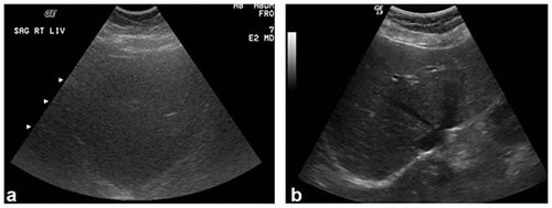 Liver ultrasound images in a patient weighing 350 lbs compared to a patient weighing 150 lbs
