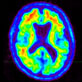 Amyloid PET scan for diagnosis