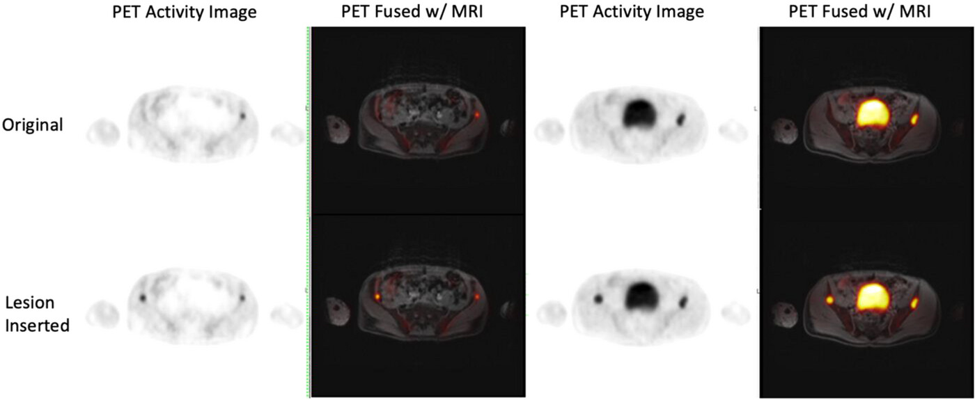 PET Activity Image and PET Fused with MRI comparison, Figure 1, DOI: 10.1002/acm2.14507 Pelvic scan images, with and without canerous lesions