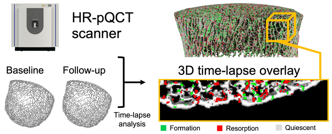 Representative baseline and follow-up HR-pQCT distal tibia scans with the time-lapse overlay visualizing bone formation and resorption evaluated by time-lapse HR-pQCT. HR-pQCT scan infographic