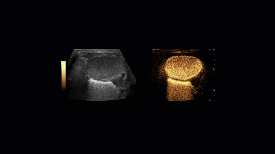 Dual screen transverse view of the urinary bladder in a female infant showing ultrasound contrast within the bladder lumen being excreted during active voiding. working bladder