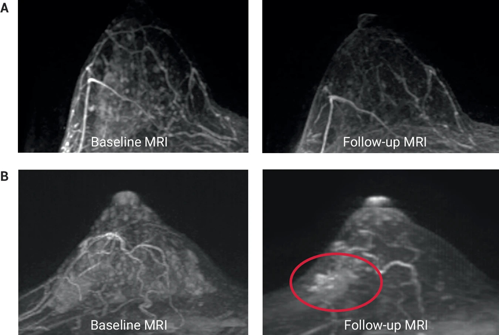 Changes in ipsilateral breast MRI features, Fig. 5, DOI:10.1038/s41523-024-00677-9 Breast scans