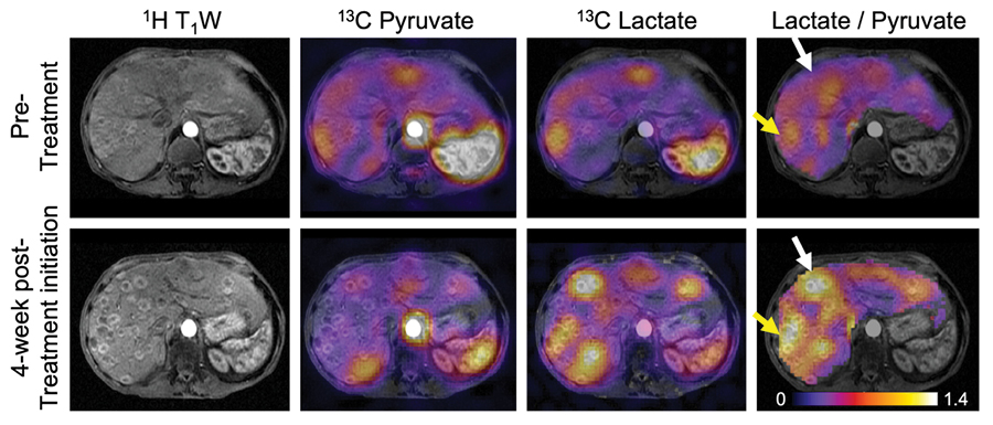 HP 13C pyruvate MRI demonstrates disease progression in liver metastases. multiple liver scans