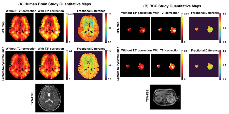 kPL maps and lactate-to-pyruvate ratio maps from (A) human healthy brain and (B) RCC patient. images of different scans