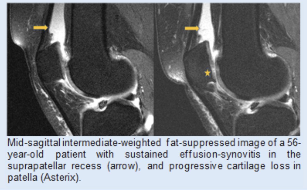 Scan of knee showing synovitis in osteoarthritis.