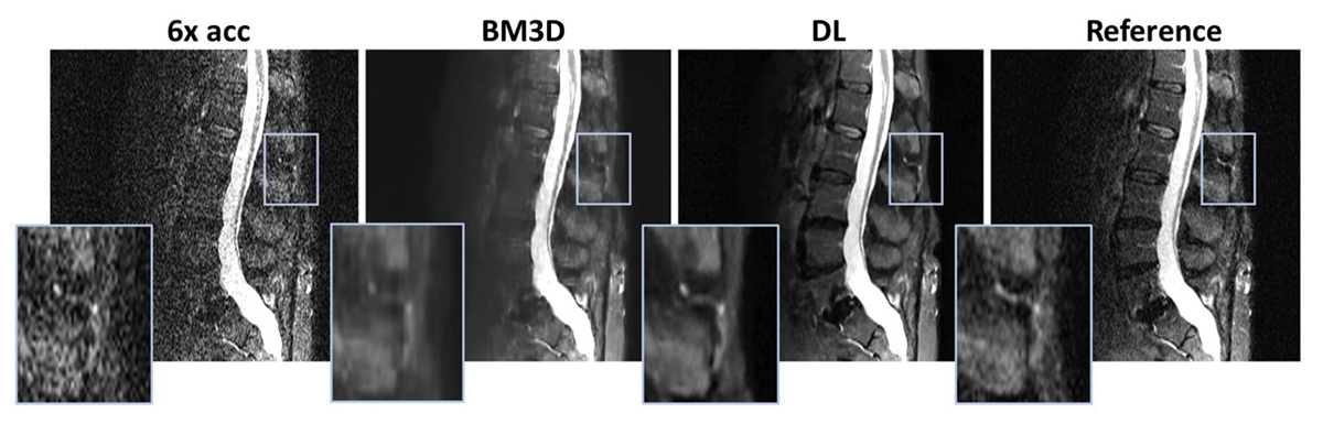 Example of sample image from Free.Max: 6-fold faster scan image without any further processing, image is noisy but faster to get. Traditional denoising using Block-matching and 3D filtering, SNR is improved by details are blurred. Deep learning denoising using spatial temporal attentions, details are well preserved while SNR is also improved. Reference clinical scan image quality, the scan time is 6 times longer than the previous 3 images. Example of an MRI image from Free.Max