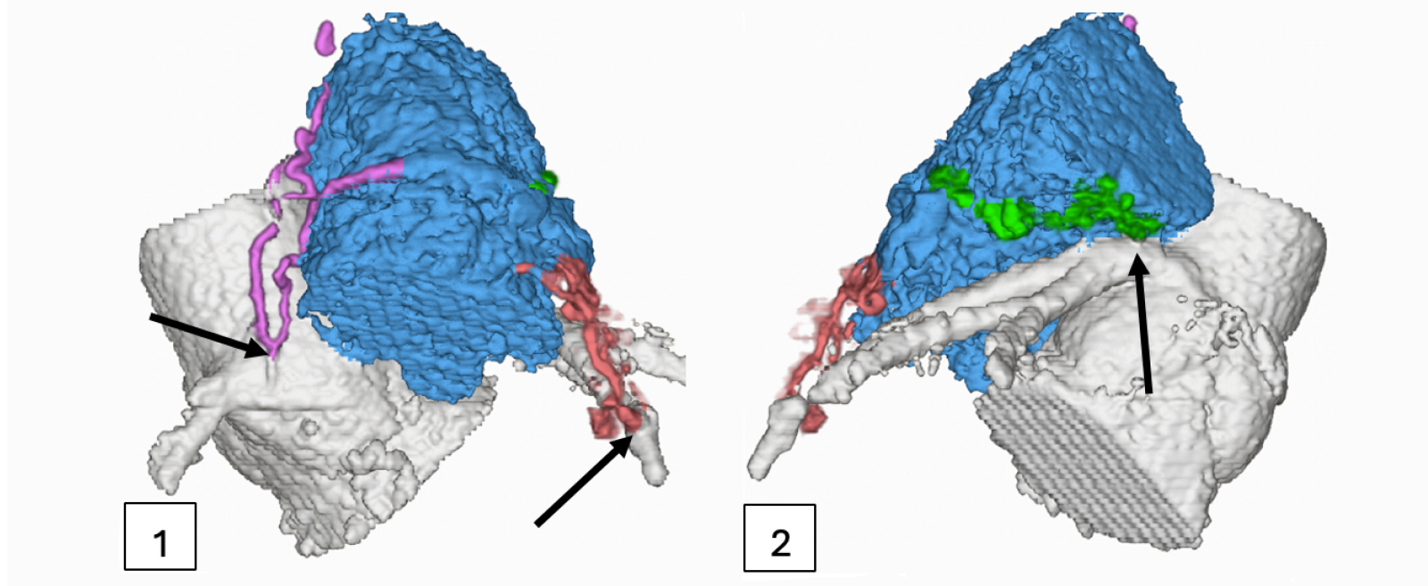 3D Modeling of two hearts