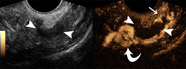 Normal HyCoSy showing a patent left fallopian tube.