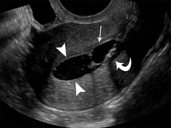Normal ultrasound hysterosonogram showing normal endometrial lining (arrowheads). Catheter (curved arrow) and balloon (arrow) are inside the uterus. Normal ultrasound hysterosonogram showing normal endometrial lining.