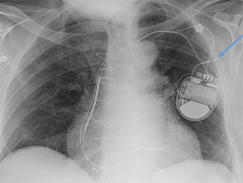 Abandon leads plus generator