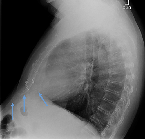 Cut epicardial wires
