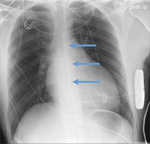 Subcutaneous defibrillator