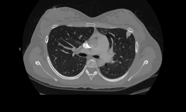 Chest CT, Pulmonary Arteriovenous Malformations (PAVMs)
