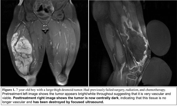 HIFU used for Desmoid Tumors
