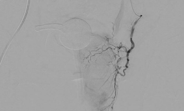 Prostate Artery Embolization (PAE)