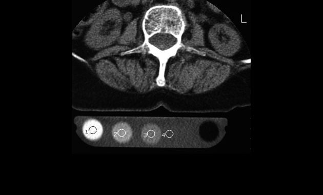 CT of the lumbar spine used for measuring the density of the bone with a calibration phantom underneath the patient.