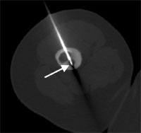 Drill in Osteoid Osteoma