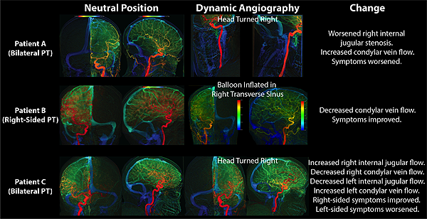 Prominent Condylar Veins Causing Pulsatile Tinnitus: Dynamic Angiographic Confirmation