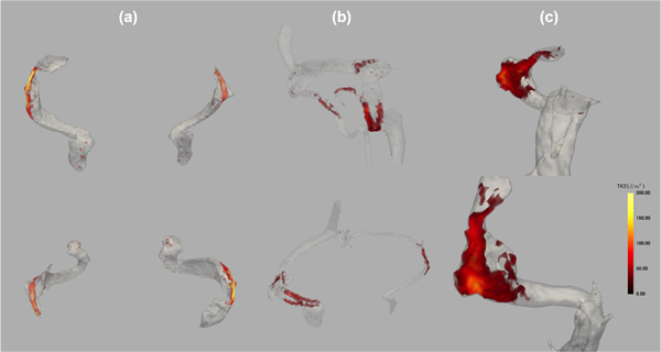 Turbulent Flow in the Venous Outflow Tract of Pulsatile Tinnitus Patients with Sigmoid Sinus Diverticulum