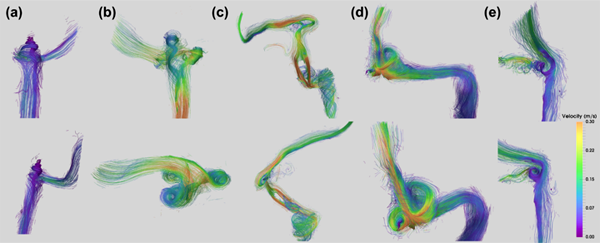 Venous Blood Flow Visualization in Sigmoid Sinus Diverticulum Using MRI