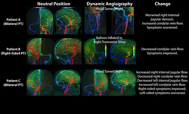 Prominent Condylar Veins Causing Pulsatile Tinnitus: Dynamic Angiographic Confirmation