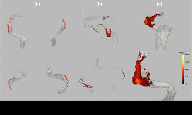 Turbulent Flow in the Venous Outflow Tract of Pulsatile Tinnitus Patients with Sigmoid Sinus Diverticulum