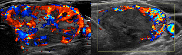 The left image is an ultrasound of a solid thyroid nodule with significant blood flow (colored blue and red). The right image is a repeat ultrasound after RFA showing a decrease in blood flow surrounding the nodule accompanied by a significant decrease in size. The left image is an ultrasound of a solid thyroid nodule with significant blood flow (colored blue and red). The right image is a repeat ultrasound after RFA showing a decrease in blood flow surrounding the nodule accompanied by a significant decrease in size.