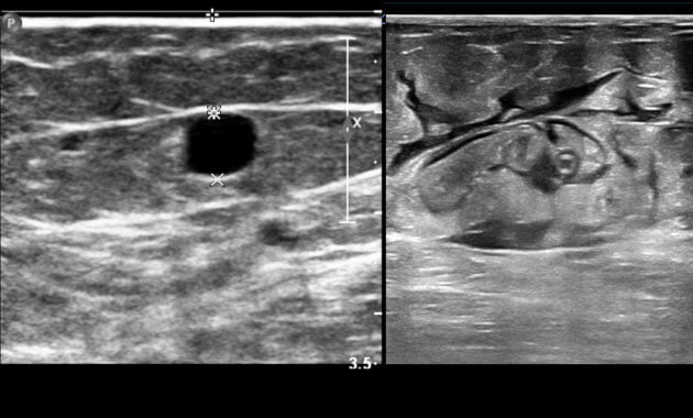 Great saphenous vein (GSV)