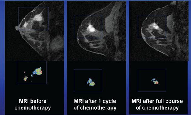 Breast MRI used to assess changes of chemotherapy