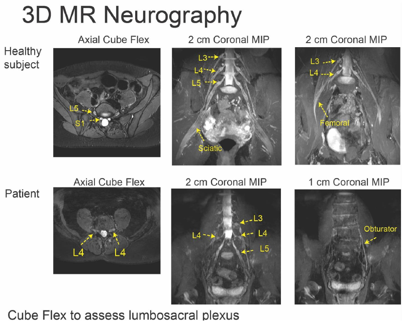 3D MR Neurography 3D MR Neurography