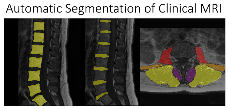 Automatic Segmentation of Clinical MRI BACPAC: Preventing and Treating Low Back Pain and Disability