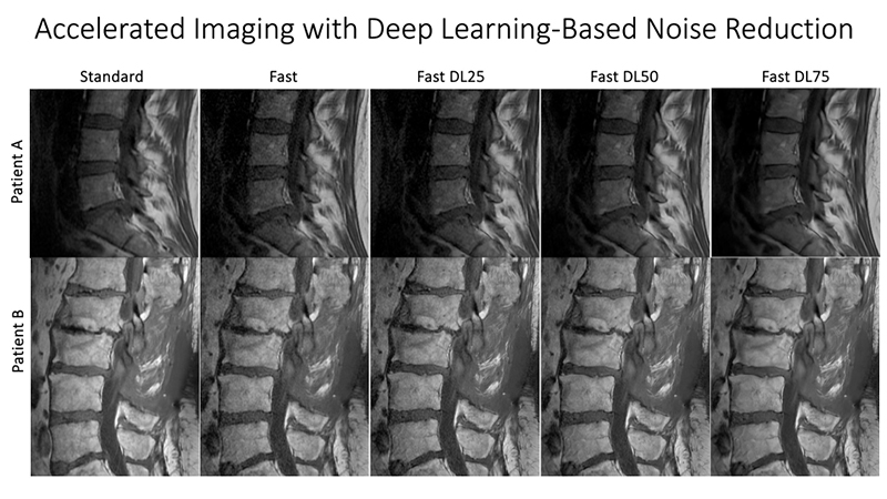 Accelerated imaging with Deep Learning-Based Noise Reduction diagram accelerated imaging deep learning noise reduction