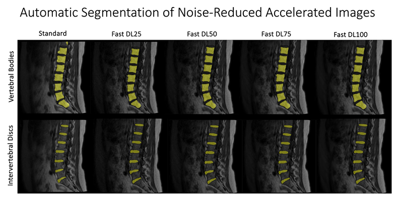 Automatic Segmentation of Noise-Reduced Accelerated Images diagram Automatic Segmentation of Noise-Reduced Accelerated Images