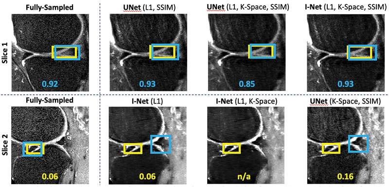 Full-Sampled, UNet (L1, SSIM) UNet (L1, K-Space, SSIM) I-Net (L1, K-Space, SSIM) Diagram: Full-Sampled, UNet (L1, SSIM) UNet (L1, K-Space, SSIM) I-Net (L1, K-Space, SSIM)