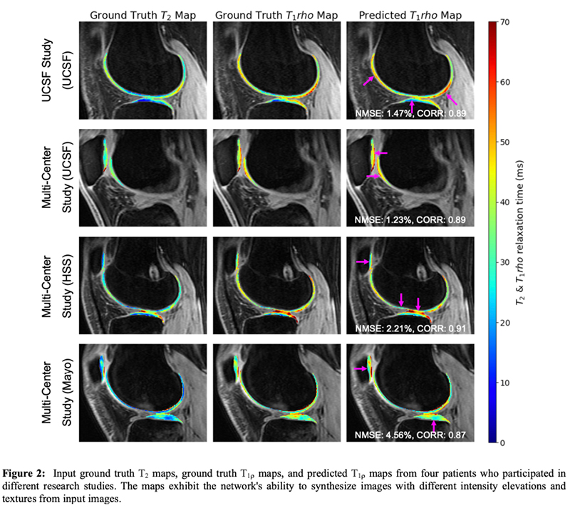 Figure 2: Input ground truth T<sub>2</sub> maps, ground truth T<sub>1</sub>ρ maps, and predicted T1p maps from four patients who participated in different research studies. The map exhibit the network's ability to synthesis images with different intensity elevations and textures from input images. diagram different intensity elevations and textures from input images.