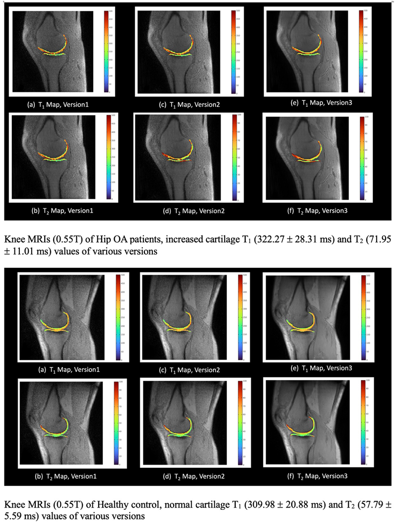 Knee MRIs (0.55T) of Hip OA patients, increased cartilage T<sub>1</sub> (322.27 ± 28.31 ms) and T<sub>2</sub> (71.95 ± ms) values of various versions. Diagram: Knee MRIs (0.55T) of Hip OA patients, increased cartilage T<sub>1</sub> (322.27 ±- 28.31 ms) and T<sub>2</sub> (71.95 ± ms) values of various versions.