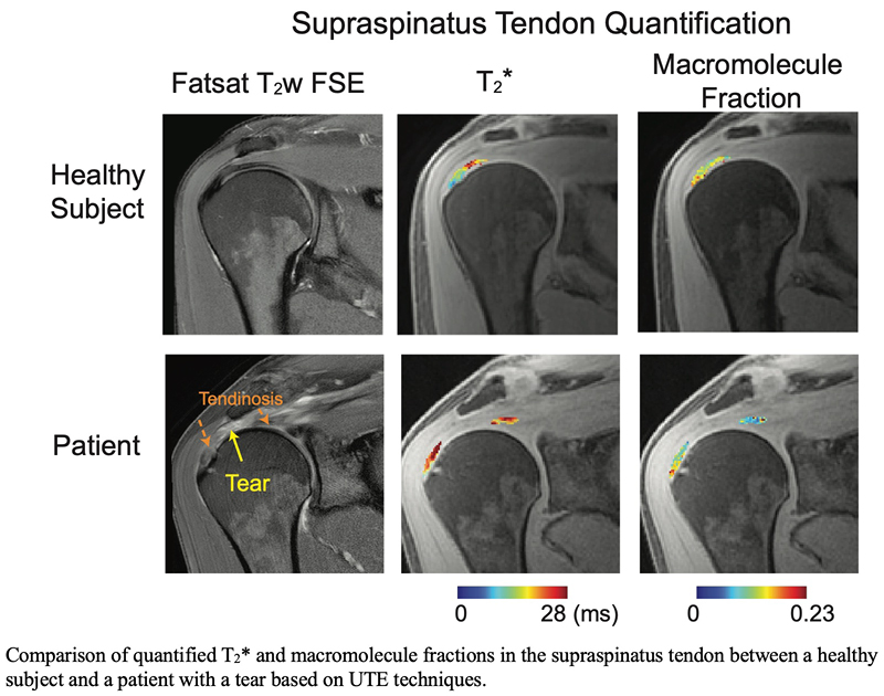 Supraspinatus Tendon Quantification: Comparison of quantified T2* and macromolecule fractions in the supraspinatus tendon between a healthy subject and a patient with a tear based on UTE techniques. Diagram: Supraspinatus Tendon Quantification