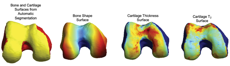 Bone and Cartilage Surface from Automatic Segmenation, Bone Shape Surface, Cartilage Thickness Surface, Cartilage T2 Surface Diagram: Bone and Cartilage Surface from Automatic Segmenation, Bone Shape Surface, Cartilage Thickness Surface, Cartilage T<sub>2</sub> Surface