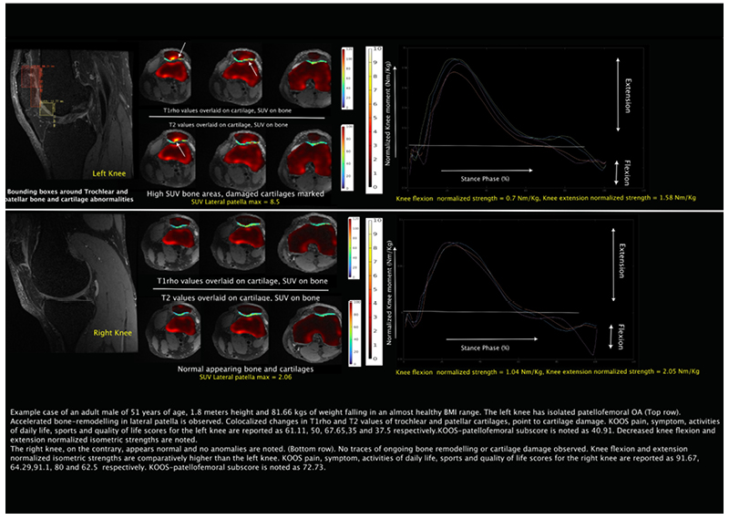 Example case of an adult male of 51 years of age, 1.8 meters height and 81.66 kgs of weight falling in an almost healthy BMI range. Bone and cartilage interaction of patellofemoral joint