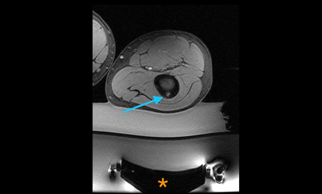 HIFU treatment of tumor