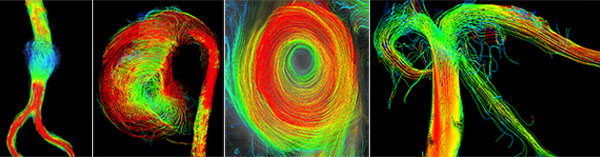 4D Flow of Abdominal Aortic Aneurysms