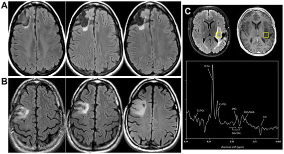 Detection of low-grade glioma and chondrosarcoma via isocitrate dehydrogenase mutants (IDHm)