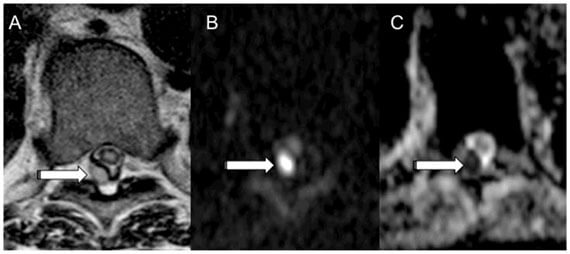 Clinical utility of diffusion-weighted imaging in spinal infections