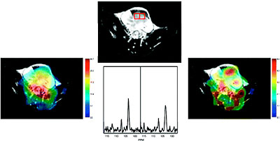 Hyperpolarized [2-13C]-fructose: a hemiketal substrate for in vivo metabolic imaging
