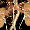 CT Angiogram