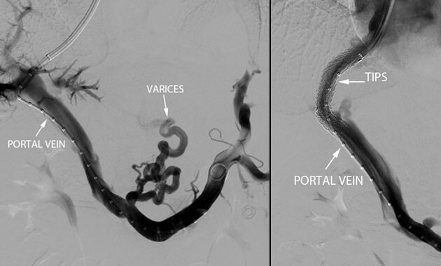 Transjugular Intrahepatic Portosystem Shunt (TIPS), the varices no longer fill