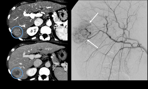 Hepatocellular carcinoma angiogram