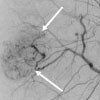 Hepatocellular carcinoma angiogram