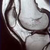 Knee MRI