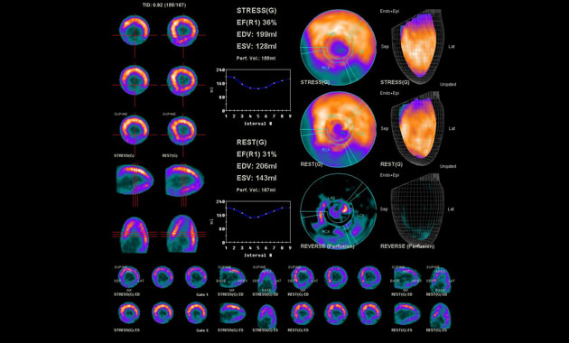 Stress/rest N13 ammonia cardiac PET